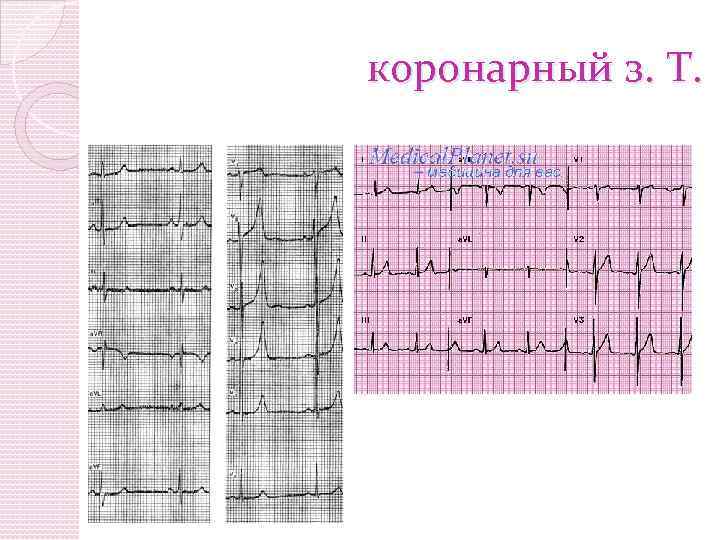  коронарный з. Т. 