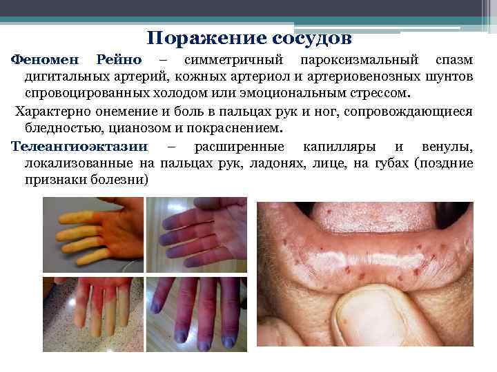  Поражение сосудов Феномен Рейно – симметричный пароксизмальный спазм дигитальных артерий, кожных артериол и