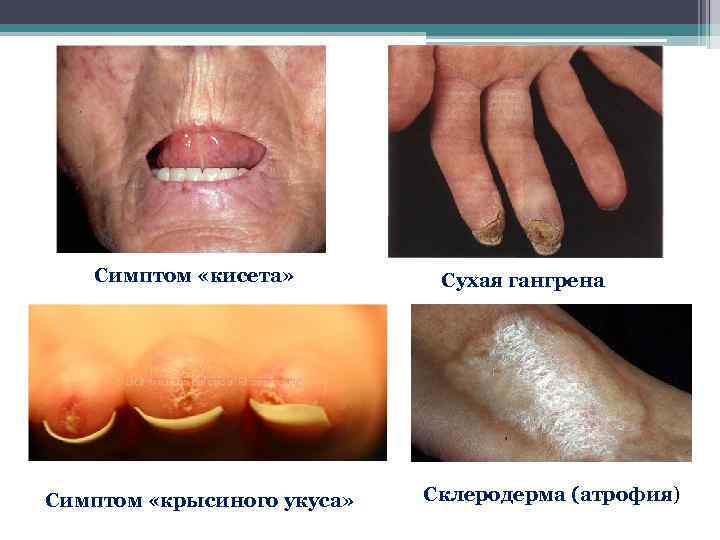 Симптом «кисета» Симптом «крысиного укуса» Сухая гангрена Склеродерма (атрофия) 