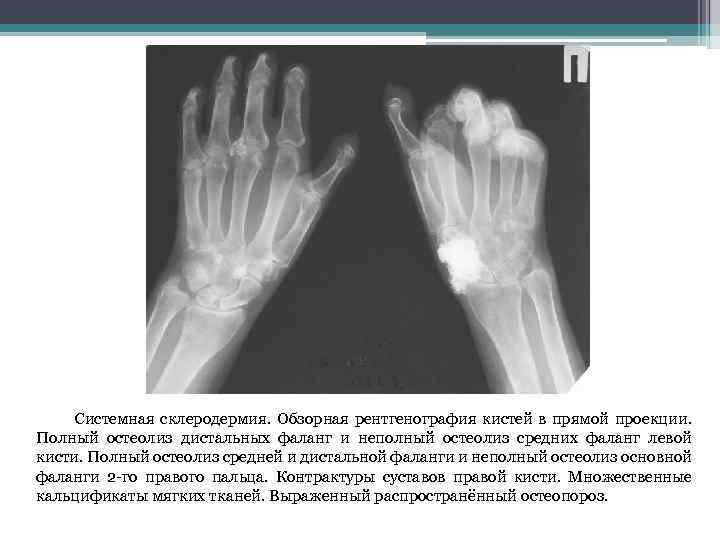  Системная склеродермия. Обзорная рентгенография кистей в прямой проекции. Полный остеолиз дистальных фаланг и