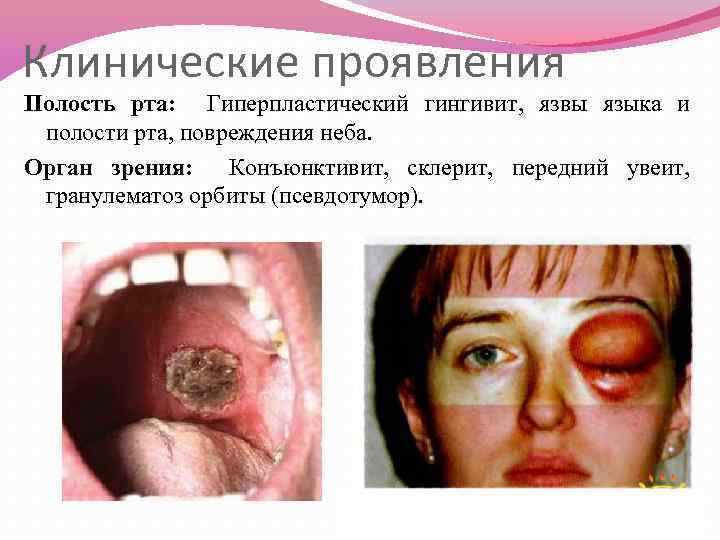 Клинические проявления Полость рта: Гиперпластический гингивит, язвы языка и полости рта, повреждения неба. Орган