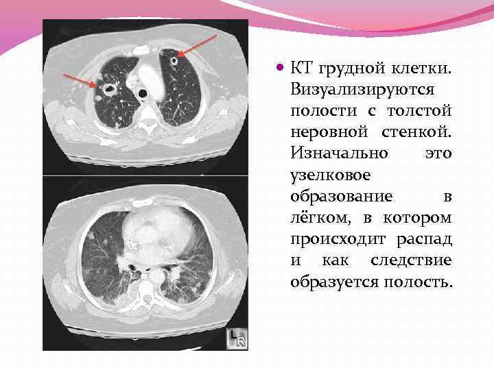  КТ грудной клетки. Визуализируются полости с толстой неровной стенкой. Изначально это узелковое образование