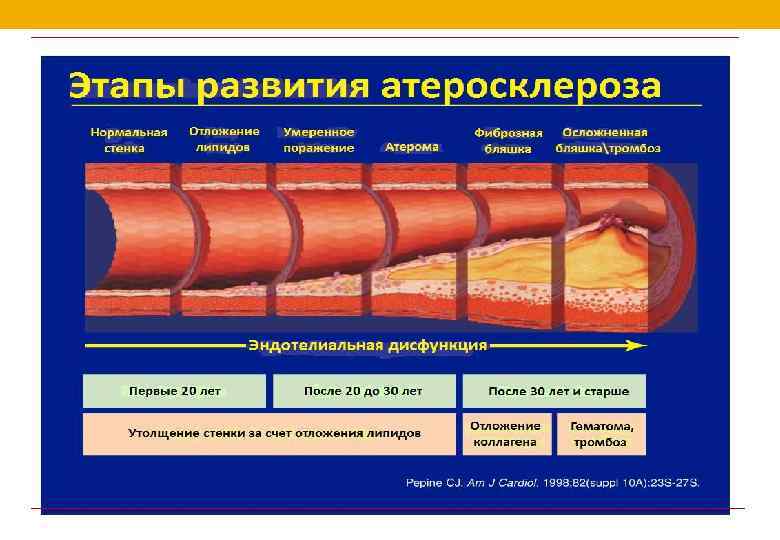 2 стадия атеросклероза. Атеросклероз стадии 1-4.