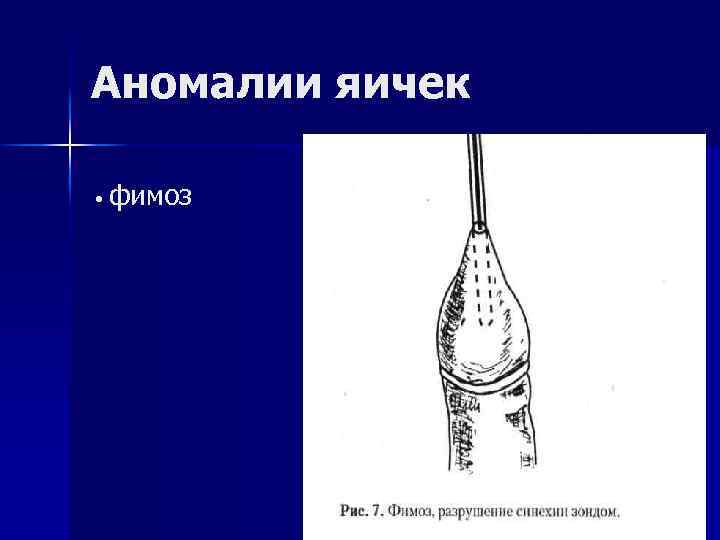 Презентация аномалии яичек