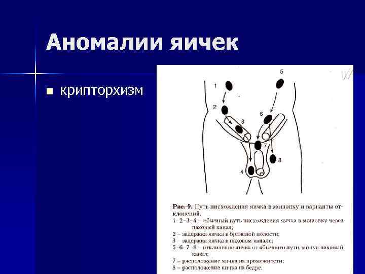 Видны яички. Крипторхизм у детей клинические рекомендации. Крипторхизм паховая ретенция. Двусторонний крипторхизм паховая форма. Двусторонний ложный крипторхизм.