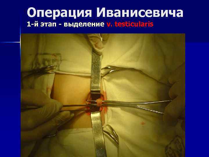 Операция Иванисевича 1 -й этап - выделение v. testicularis 