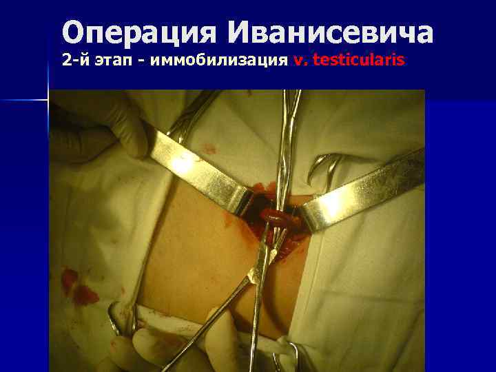 Операция Иванисевича 2 -й этап - иммобилизация v. testicularis 