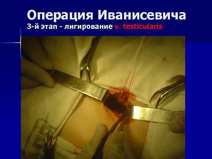 Операция Иванисевича 3 -й этап - лигирование v. testicularis 