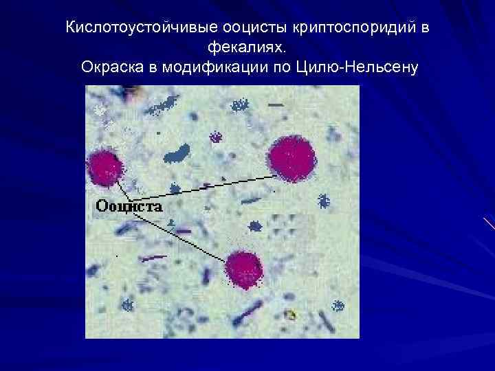 Кислотоустойчивые ооцисты криптоспоридий в фекалиях. Окраска в модификации по Цилю Нельсену 