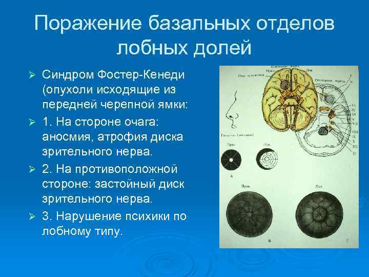 Поражение базальных отделов лобных долей Синдром Фостер-Кенеди (опухоли исходящие из передней черепной ямки: Ø