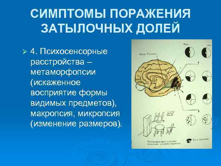 Синдром поражения затылочной доли мозга. Синдромы поражения затылочных долей головного мозга. Симптомы поражения затылочной доли. Синдром поражения затылочной доли неврология.