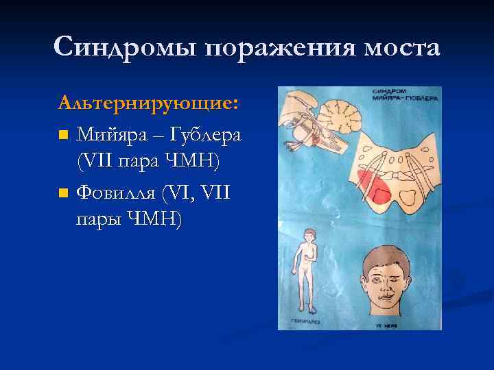 Синдромы поражения моста Альтернирующие: n Мийяра – Гублера (VII пара ЧМН) n Фовилля (VI,