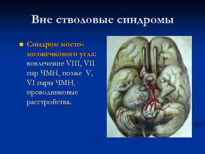 Вне стволовые синдромы n Синдром мостомозжечкового угла: вовлечение VIII, VII пар ЧМН, позже V,