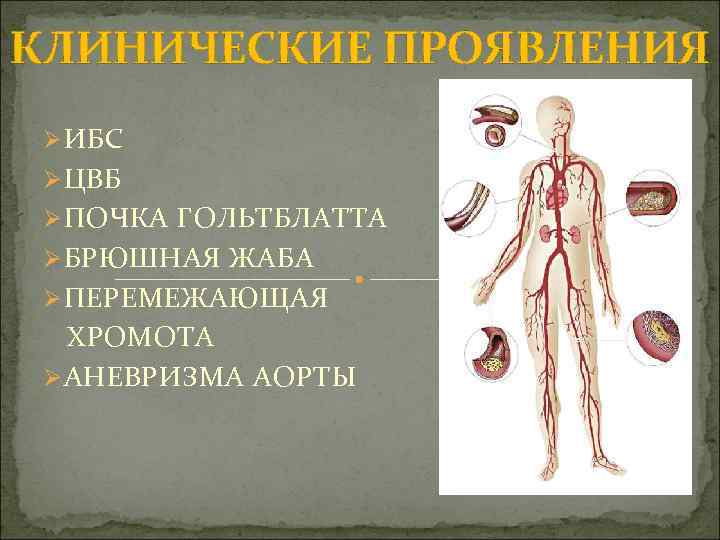 КЛИНИЧЕСКИЕ ПРОЯВЛЕНИЯ Ø ИБС Ø ЦВБ Ø ПОЧКА ГОЛЬТБЛАТТА Ø БРЮШНАЯ ЖАБА Ø ПЕРЕМЕЖАЮЩАЯ
