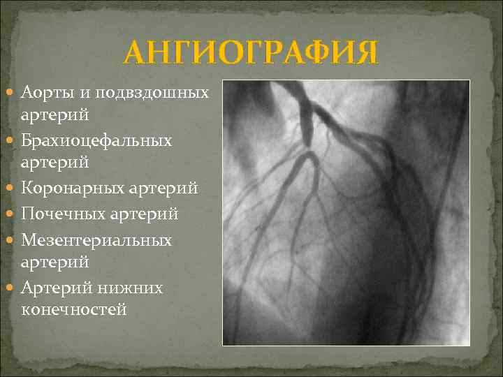 АНГИОГРАФИЯ Аорты и подвздошных артерий Брахиоцефальных артерий Коронарных артерий Почечных артерий Мезентериальных артерий Артерий