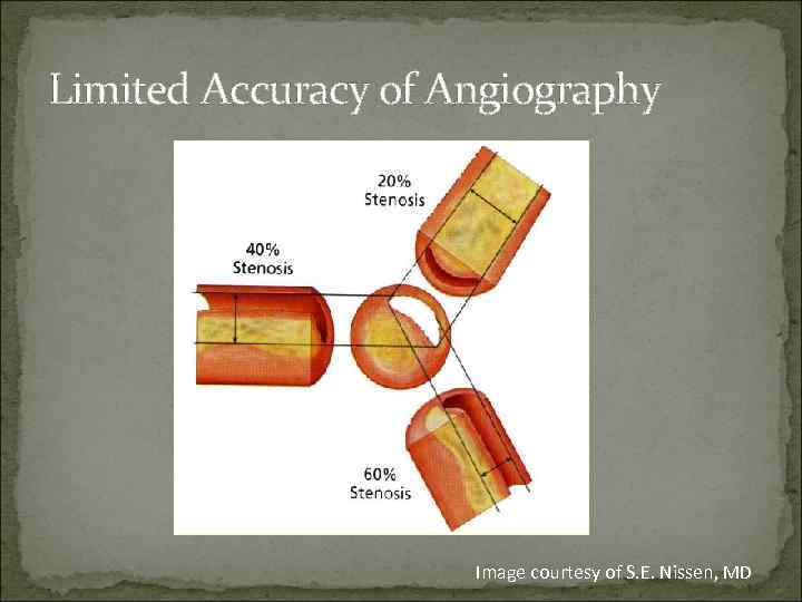 Limited Accuracy of Angiography Image courtesy of S. E. Nissen, MD 