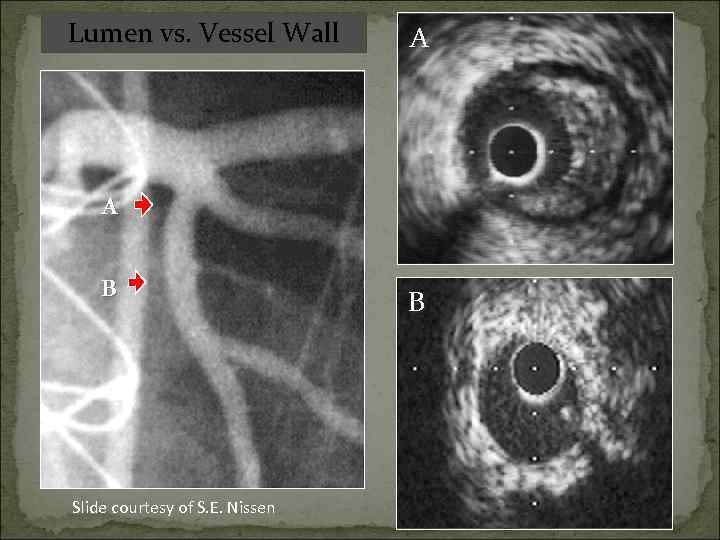 Lumen vs. Vessel Wall A A B Slide courtesy of S. E. Nissen B