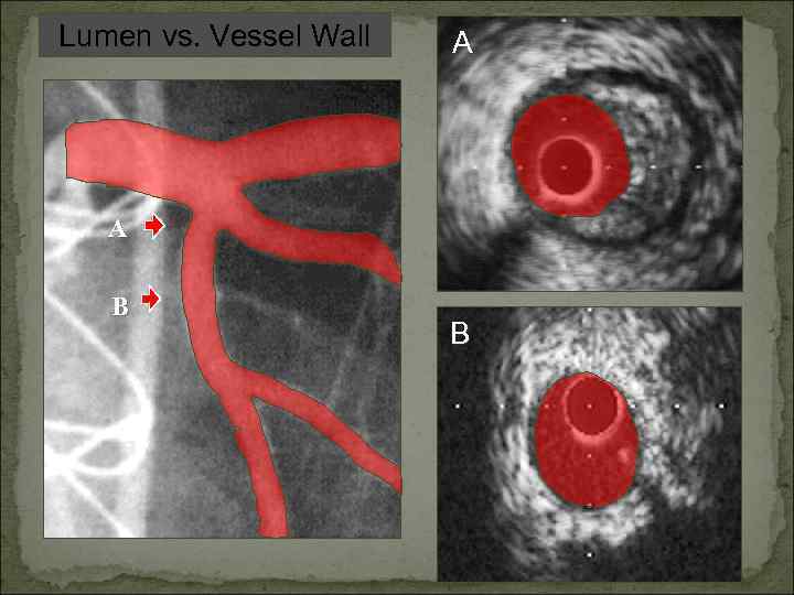 Lumen vs. Vessel Wall A A B B 