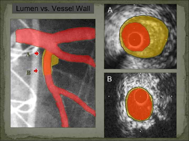 Lumen vs. Vessel Wall A A B B 