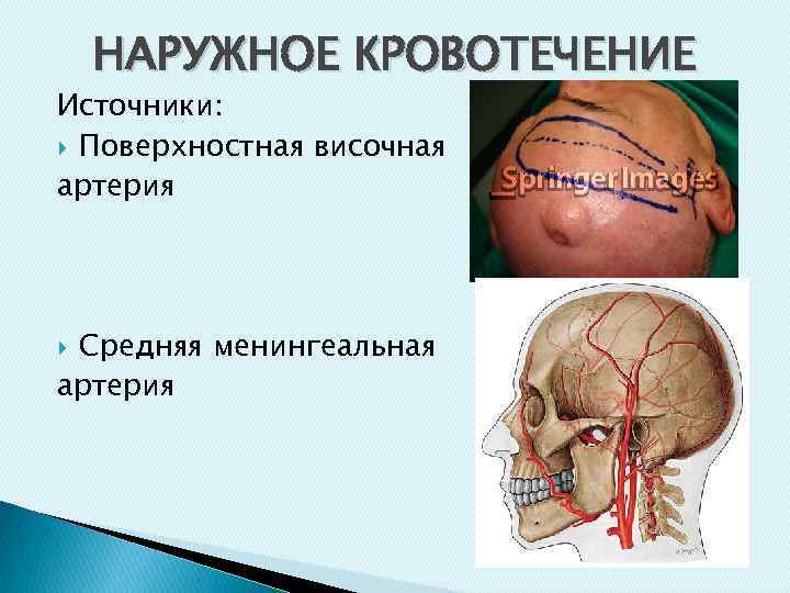 НАРУЖНОЕ КРОВОТЕЧЕНИЕ Источники: Поверхностная височная артерия Средняя менингеальная артерия 