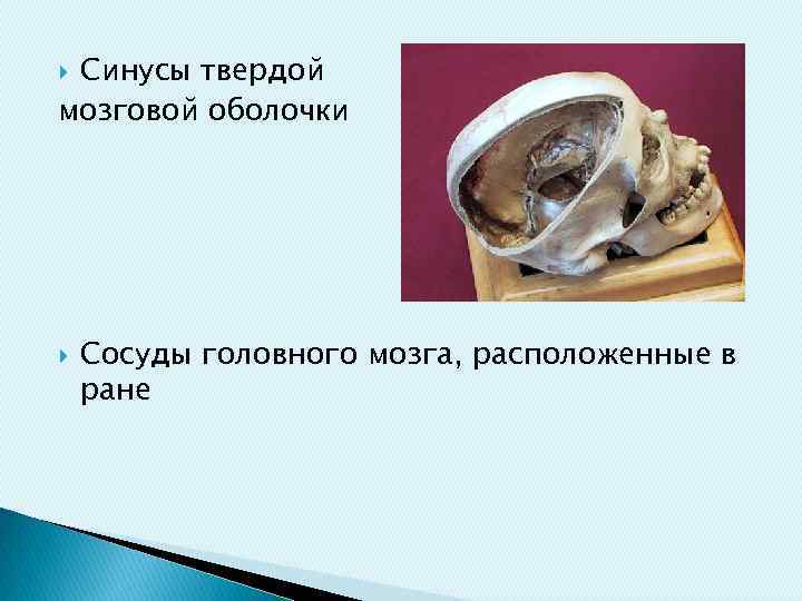 Синусы твердой мозговой оболочки Сосуды головного мозга, расположенные в ране 