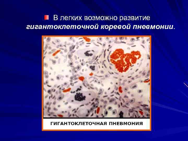 В легких возможно развитие гигантоклеточной коревой пневмонии. 
