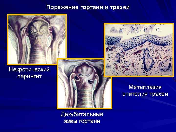 Некротический фасциит фото больных