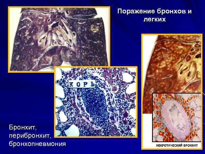 Поражение бронхов и легких Бронхит, перибронхит, бронхопневмония 