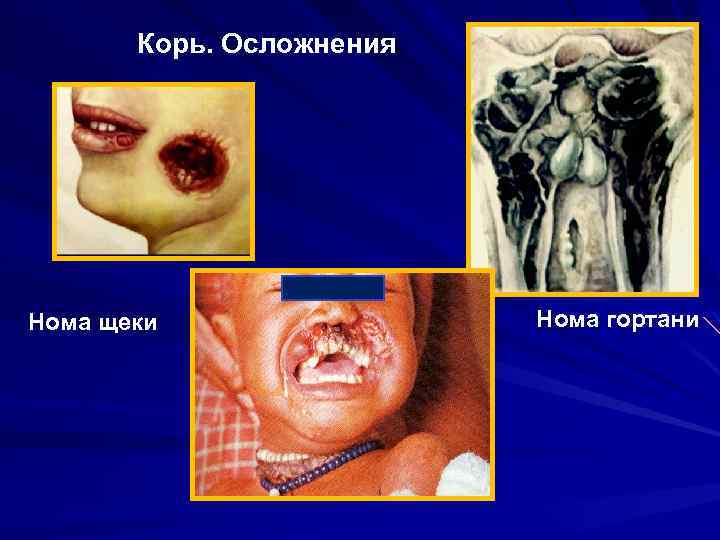 Корь. Осложнения Нома щеки Нома гортани 
