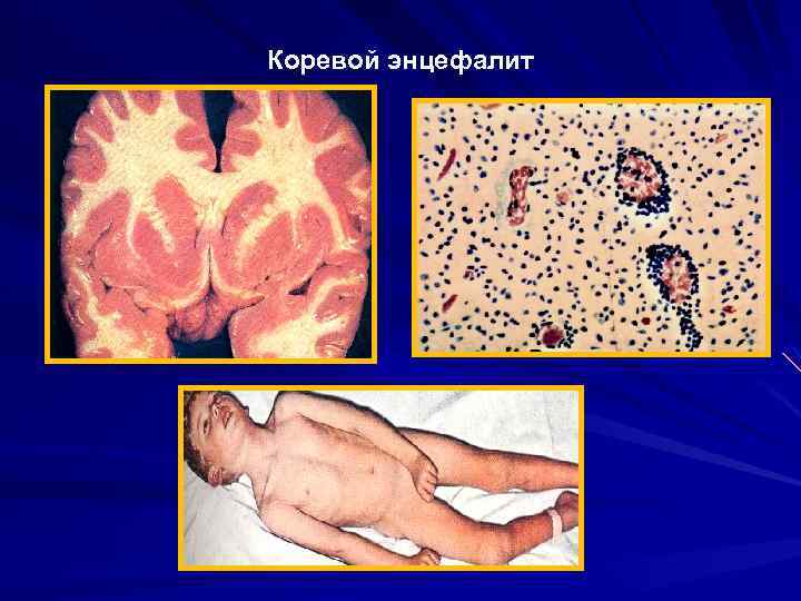 Коревой энцефалит 