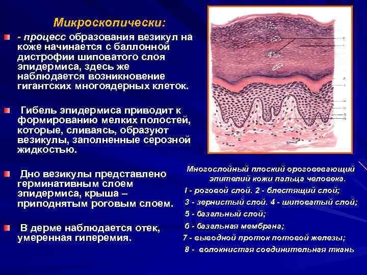 Микроскопически: - процесс образования везикул на коже начинается с баллонной дистрофии шиповатого слоя эпидермиса,