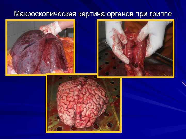 Макроскопическая картина органов при гриппе 