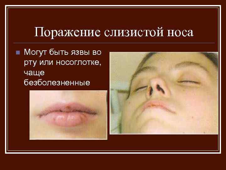 Поражение слизистой носа n Могут быть язвы во рту или носоглотке, чаще безболезненные 