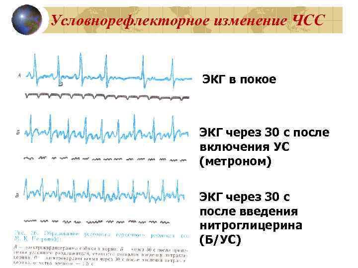 Условнорефлекторное изменение ЧСС ЭКГ в покое ЭКГ через 30 с после включения УС (метроном)