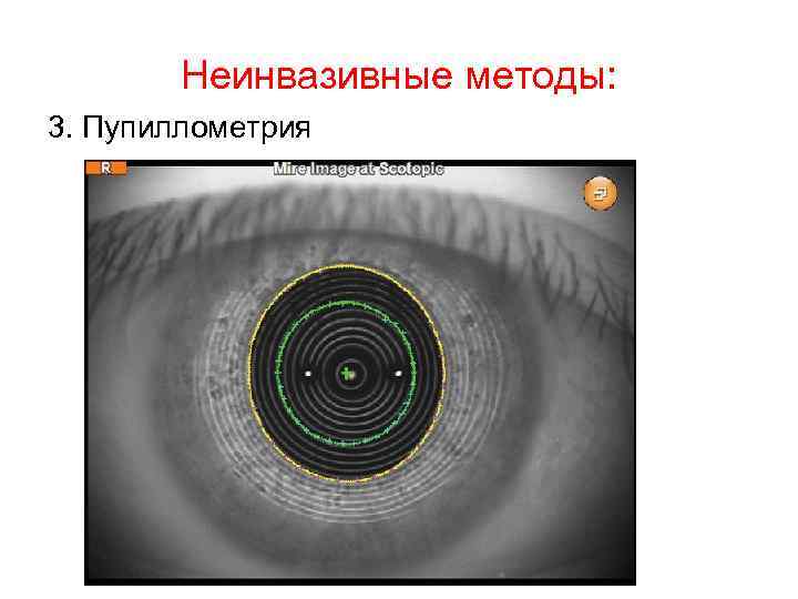 Неинвазивные методы: 3. Пупиллометрия 