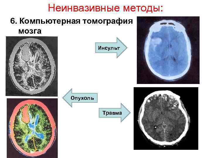 Показывает ли компьютерная томография инсульт