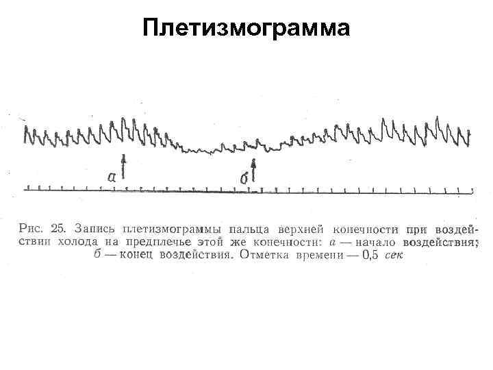 Плетизмограмма 
