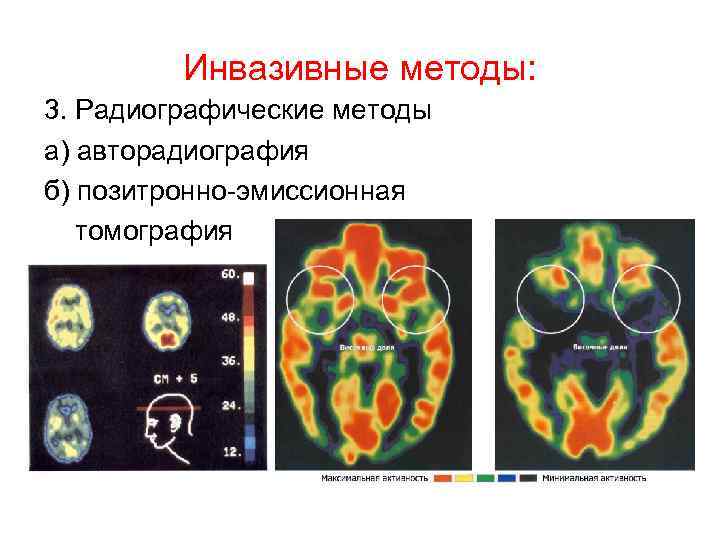 Инвазивные методы: 3. Радиографические методы а) авторадиография б) позитронно-эмиссионная томография 