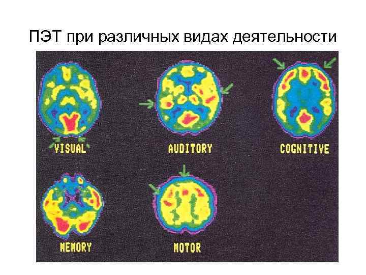 ПЭТ при различных видах деятельности 