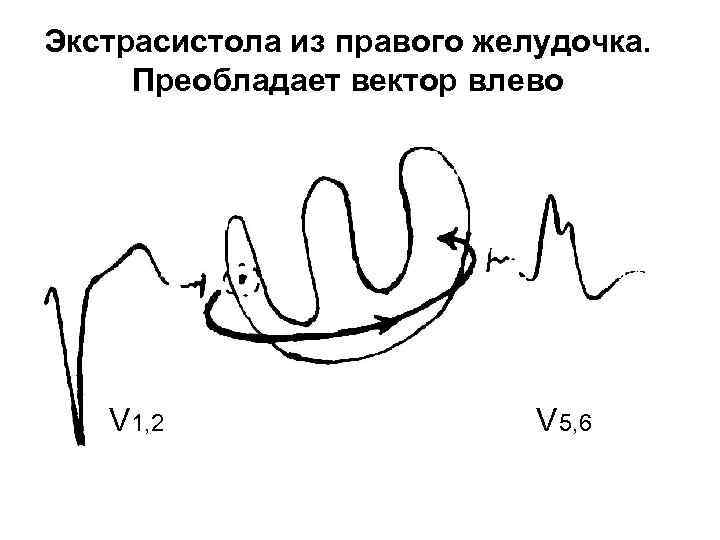 Экстрасистола из правого желудочка. Преобладает вектор влево V 1, 2 V 5, 6 