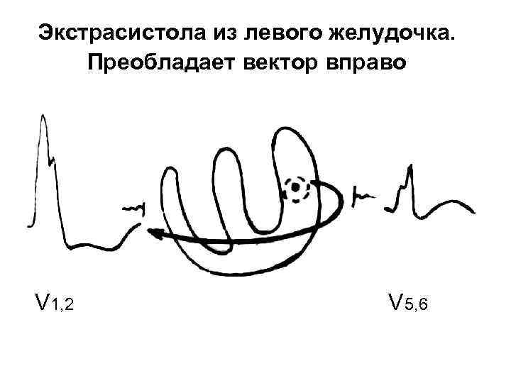 Экстрасистола из левого желудочка. Преобладает вектор вправо V 1, 2 V 5, 6 