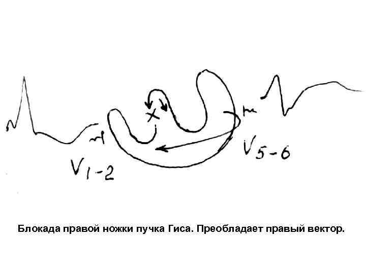 Блокада правой ножки пучка Гиса. Преобладает правый вектор. 