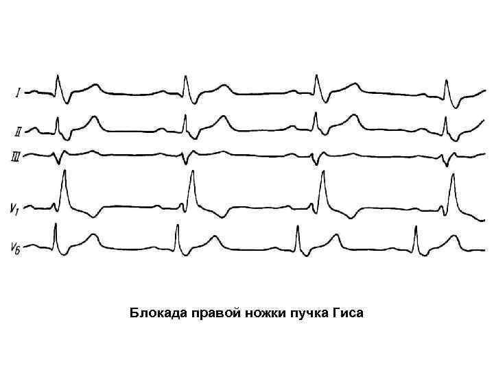 Блокада правой ножки пучка Гиса 