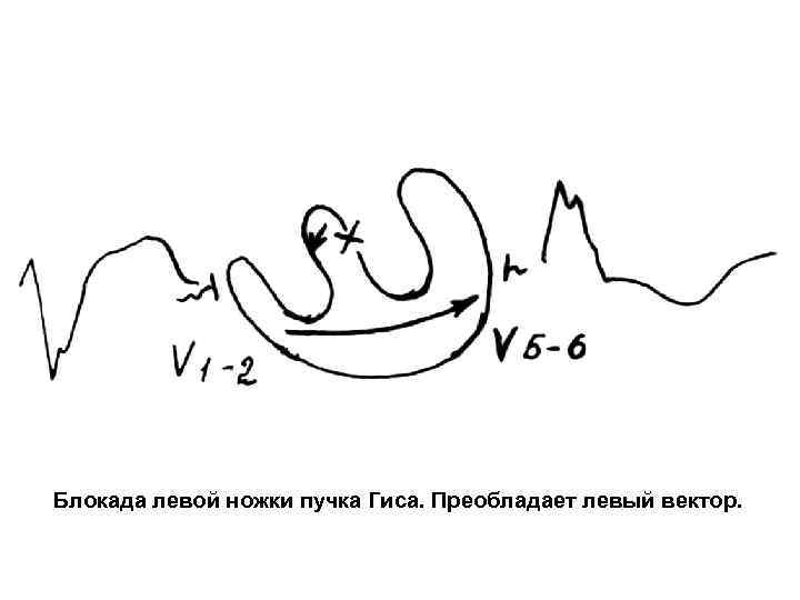 Блокада левой ножки пучка Гиса. Преобладает левый вектор. 