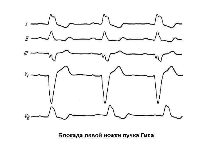 Блокада левой ножки пучка Гиса 