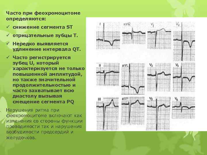 Часто при феохромоцитоме определяются: ü снижение сегмента ST ü отрицательные зубцы Т. ü Нередко