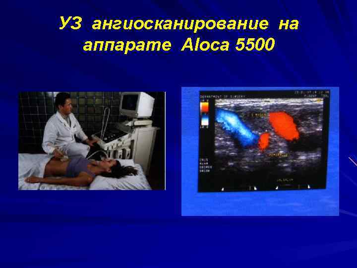 УЗ ангиосканирование на аппарате Aloca 5500 