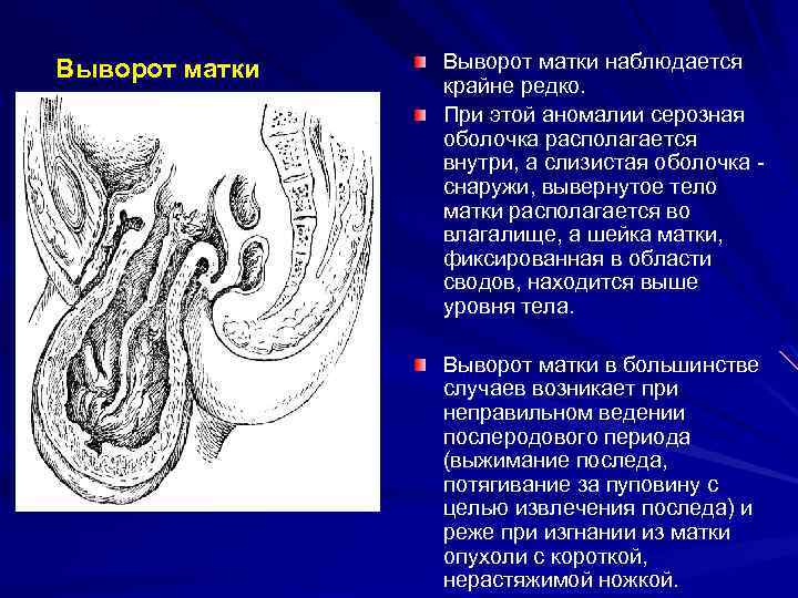 Выворот матки наблюдается крайне редко. При этой аномалии серозная оболочка располагается внутри, а слизистая