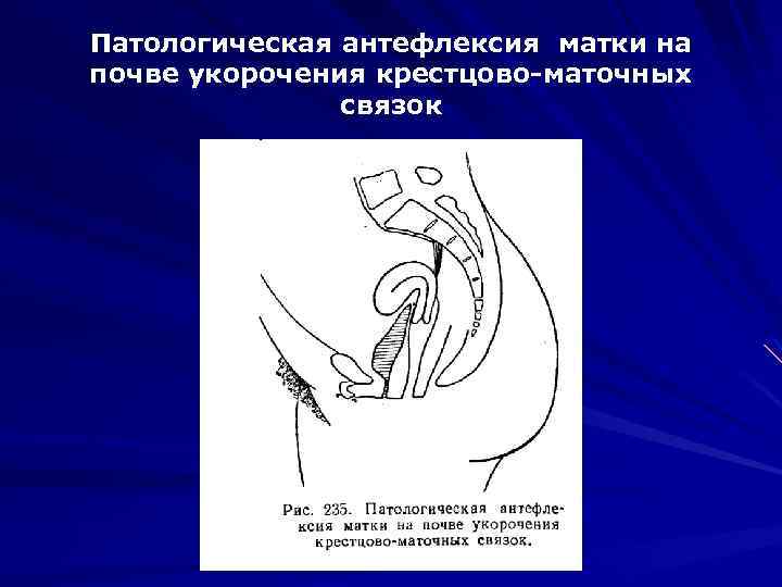 Патологическая антефлексия матки на почве укорочения крестцово-маточных связок 