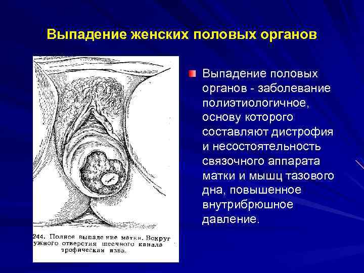 Выпадение женских половых органов Выпадение половых органов - заболевание полиэтиологичное, основу которого составляют дистрофия